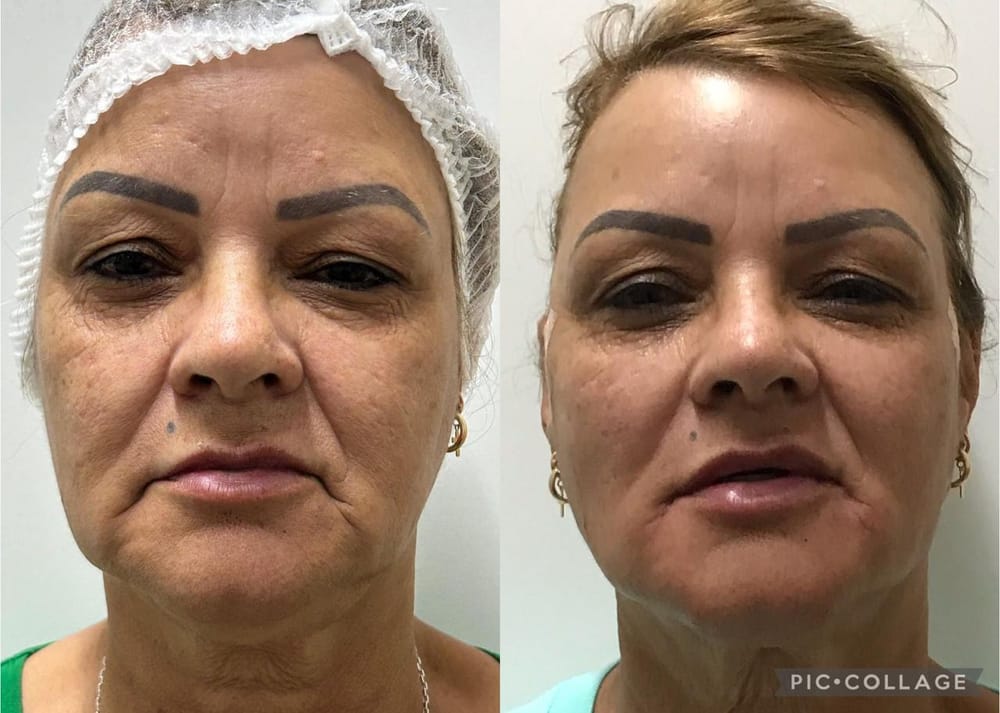 Facial