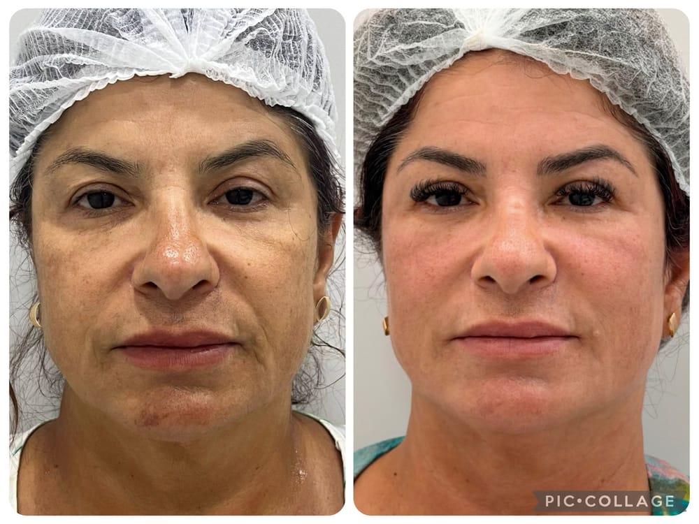 Facial
