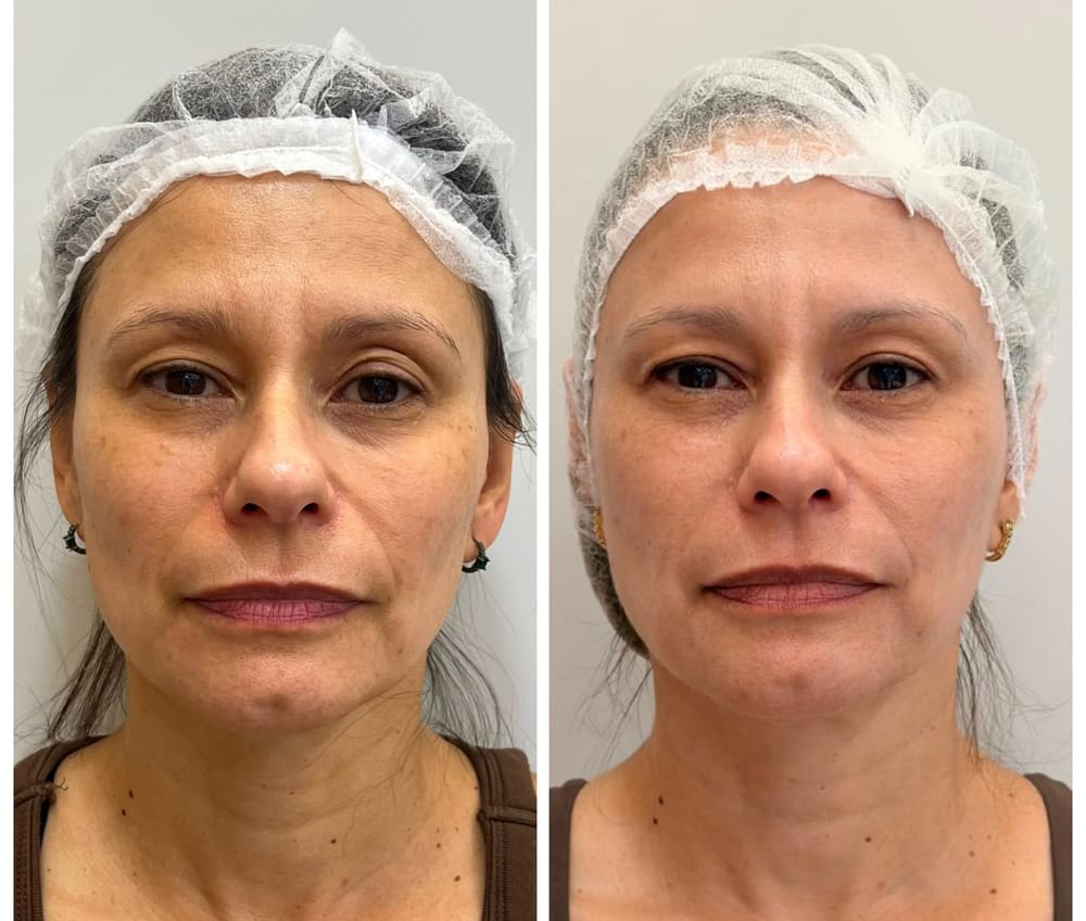 Facial