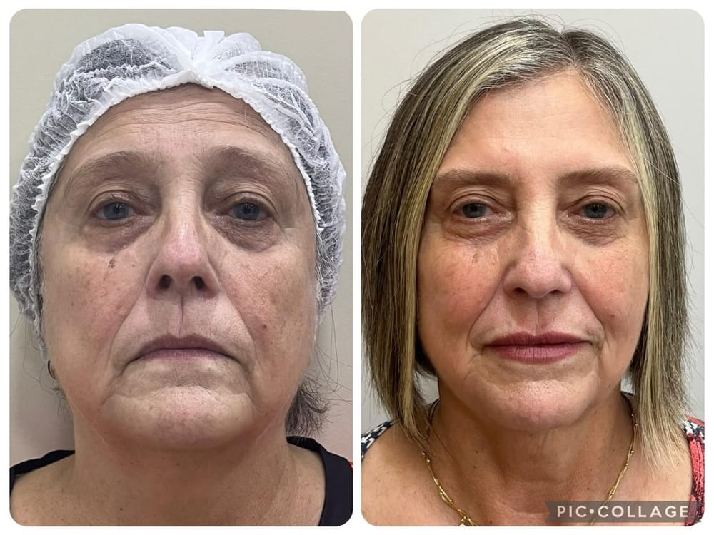 Facial