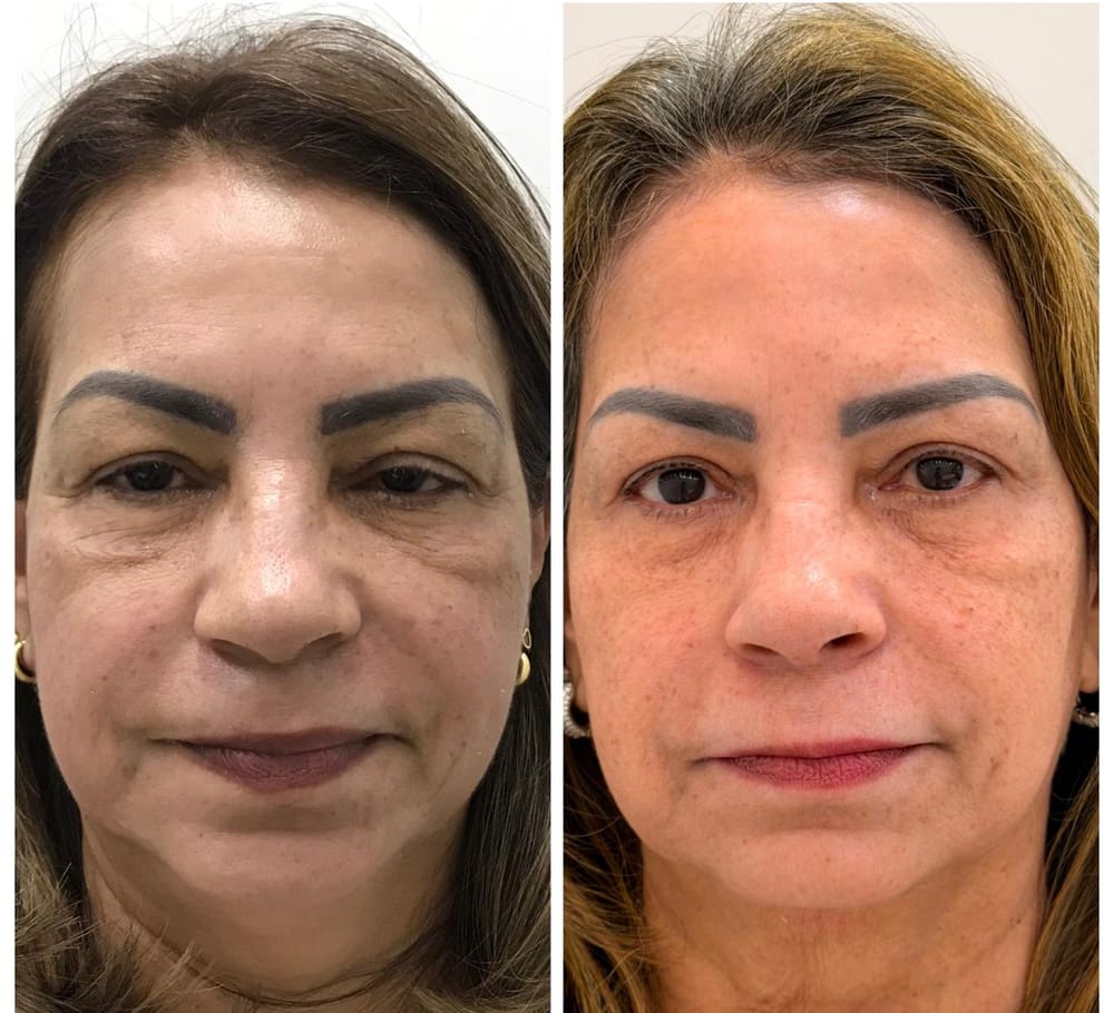 Facial