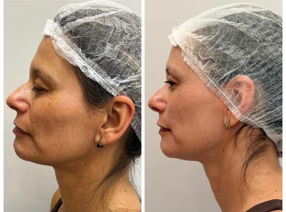 Facial