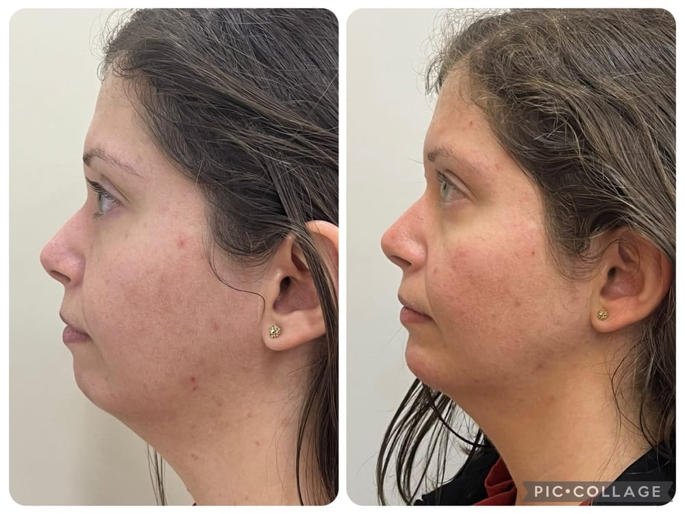 Facial