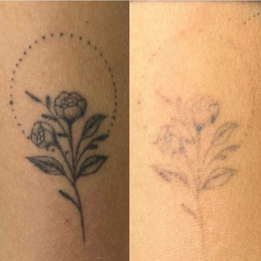 Remoção de tatuagem
