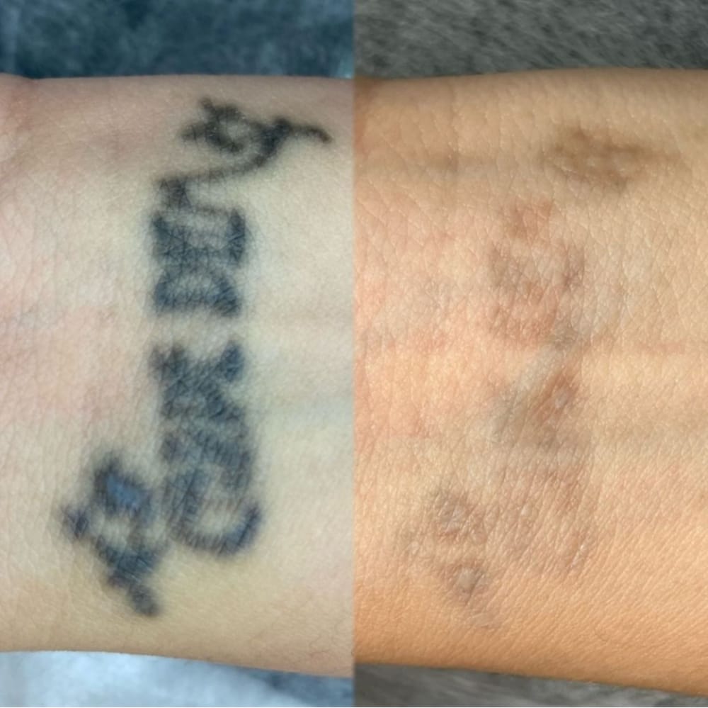 Remoção de tatuagem